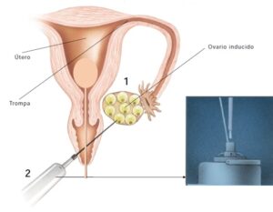 estimulación ovárica